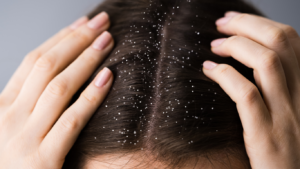 Combate à Caspa e Queda de Cabelo: A Eficácia dos Sabonetes Naturais